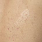 Close-up texture shot of Salicylic Acid 0.5% Body Serum. The clear, lightweight gel is shown applied directly to skin with some visible body acne, demonstrating its consistency.